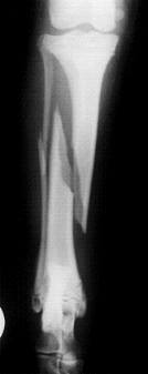 tibia1